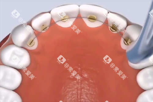 舌侧矫正动画模拟 舌侧矫正动画模拟