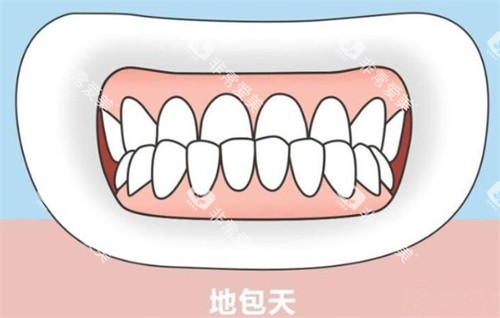 地包天卡通示意图 地包天卡通示意图