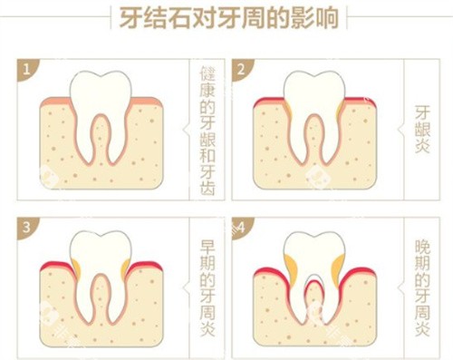 牙结石对牙周的影响 牙结石对牙周的影响