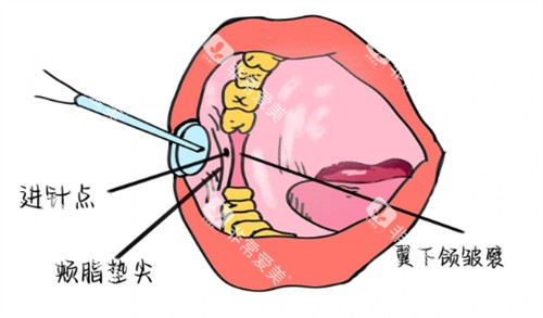 牙周内注射麻醉 牙周内注射麻醉