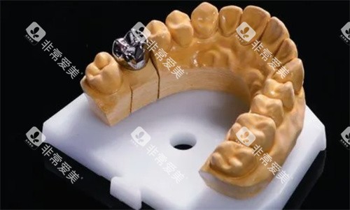 廊坊三河紫丁香口腔种植牙纯钛一体冠