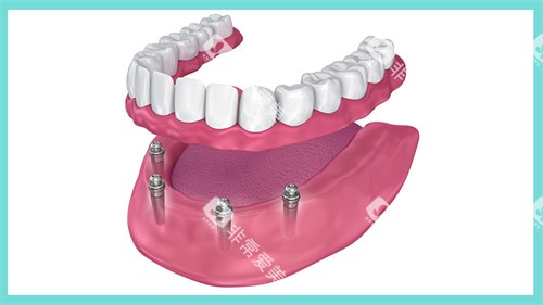 夏津淑志口腔半口种植牙动画展示图