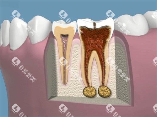 牙齿龋坏根管治疗前