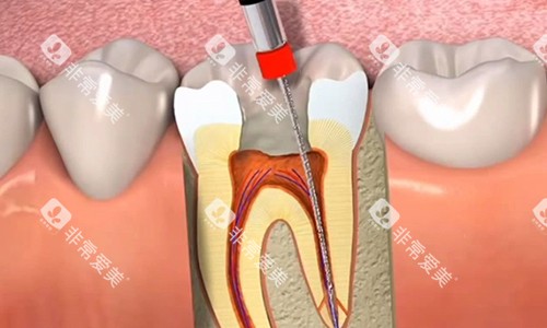根管治疗中的过程