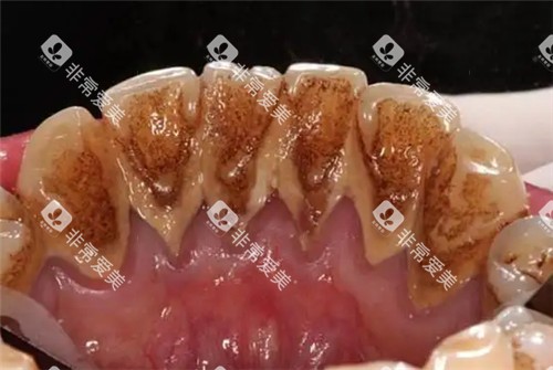 牙结石照片