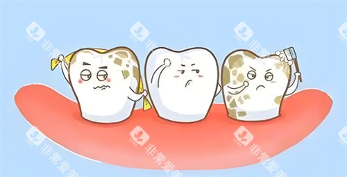 牙结石