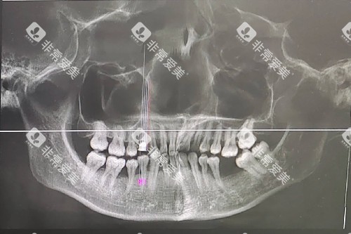牙周炎 牙龈萎缩 缺牙