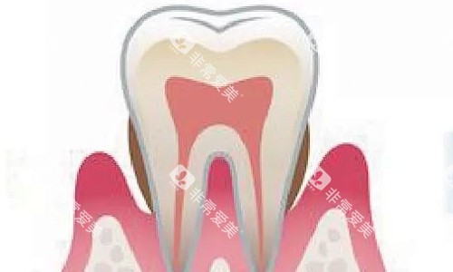 中午牙周炎展示