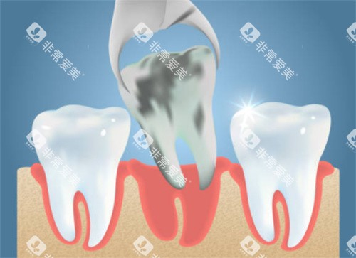 拔掉坏的牙齿