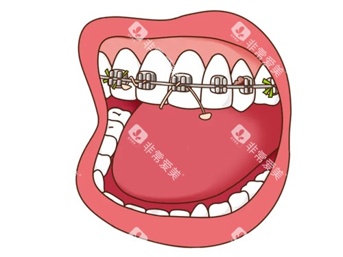 牙齿矫正牙套口腔漫画图