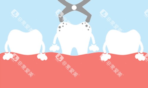拔除龋齿展示