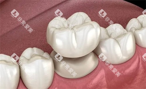 牙冠是怎么做的