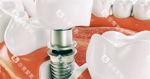 单颗种植牙演示