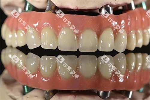 马龙桥全口细节示意图 马龙桥全口细节示意图