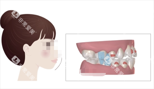 正雅隐形矫正S8突面矫正展示 正雅隐形矫正S8突面矫正展示