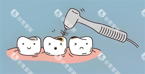 龋齿治疗动画展示图