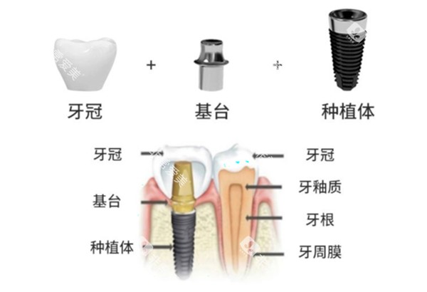 威高种植牙手术过程示意图