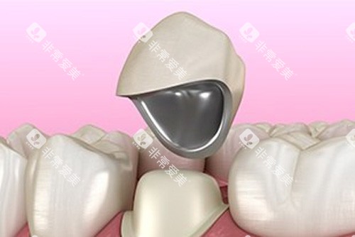 牙冠修复示意图