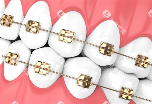 金属牙齿矫正 金属牙齿矫正