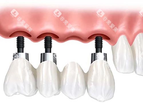 种植牙固定桥修复体