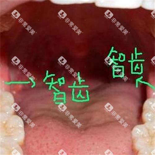 牙齿智齿所在位置