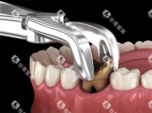 拔掉龋坏的牙齿