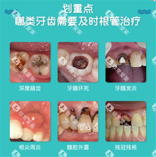 根管治疗适应症