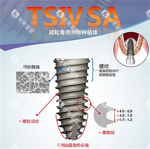 奥齿泰种植牙表面优势 奥齿泰种植牙表面优势