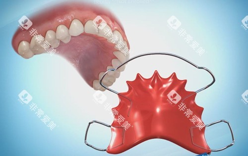 哈雷保持器实物示意图 哈雷保持器实物示意图