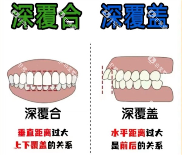 深覆合跟深覆盖的区别对比 深覆合跟深覆盖的区别对比