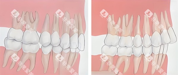 深覆合跟深覆盖对比图片 深覆合跟深覆盖对比图片