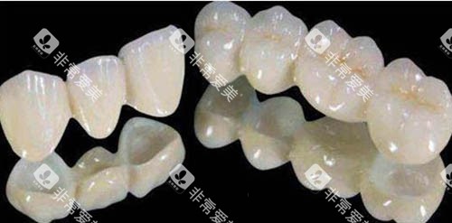全瓷牙套照片