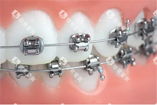 金属托槽矫正动画图示