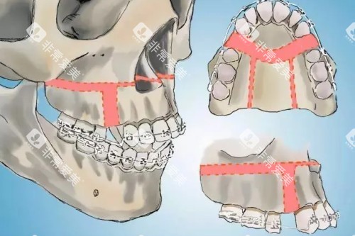 正颌手术示意图 正颌手术示意图