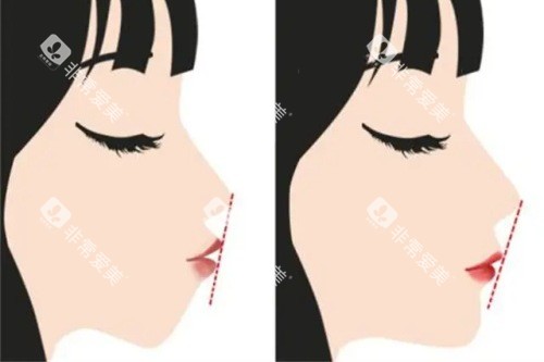 正颌手术前后的对比图 正颌手术前后的对比图