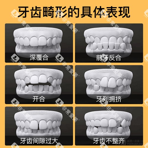 牙齿畸形形式