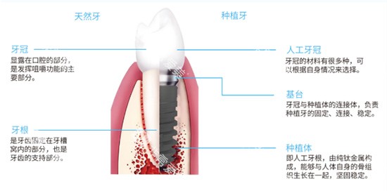 种植牙结构分析图片