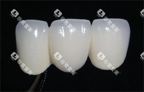 全瓷牙图