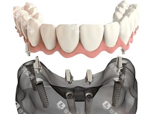 半口种植牙联排牙冠安装示意图 半口种植牙联排牙冠安装示意图