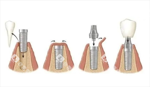 奥齿泰种植牙 奥齿泰种植牙