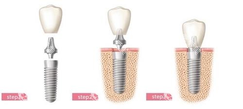 种植牙的步骤。 种植牙的步骤。