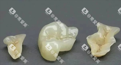 牙齿修复材料图