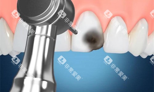 牙齿修复操作卡通图