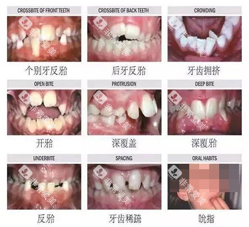 牙齿矫正不同类型的适应症