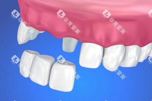 镶牙具体安装图