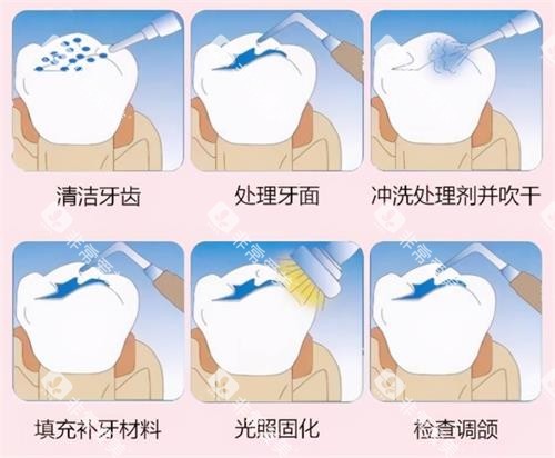 补牙的过程