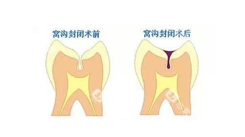 窝沟封闭后的成效