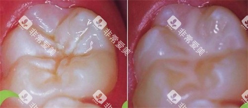 窝沟封闭前后
