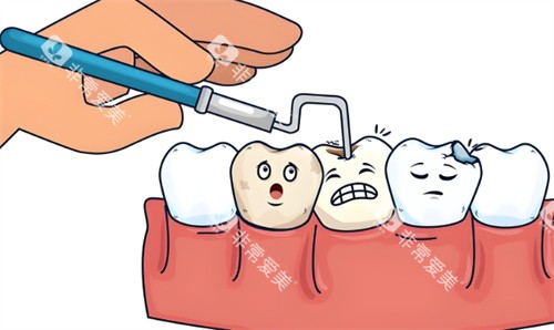 补牙手术项目动画 补牙手术项目动画