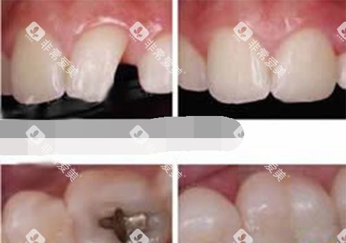 补牙过程 补牙过程